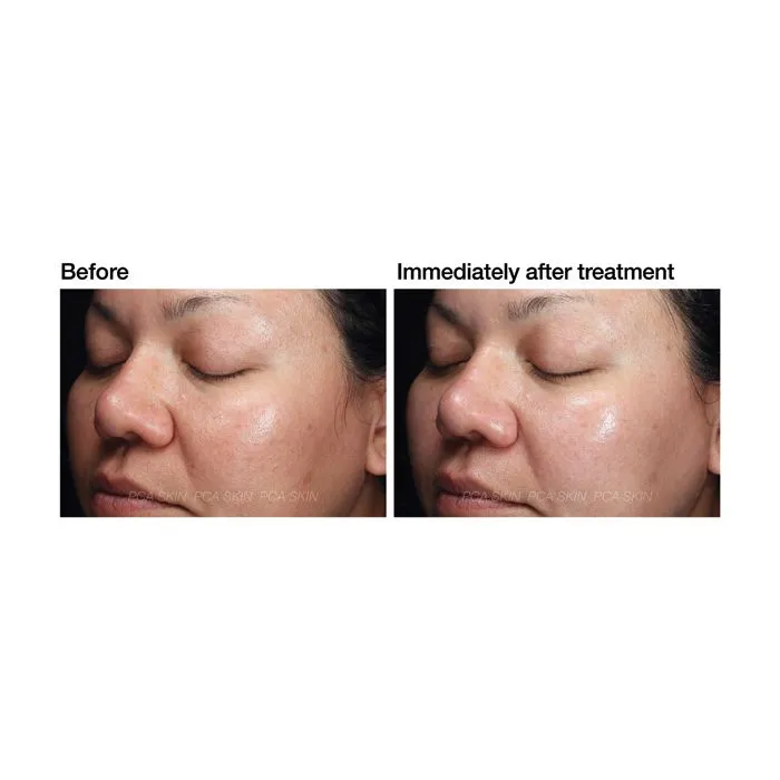 Micro Peel