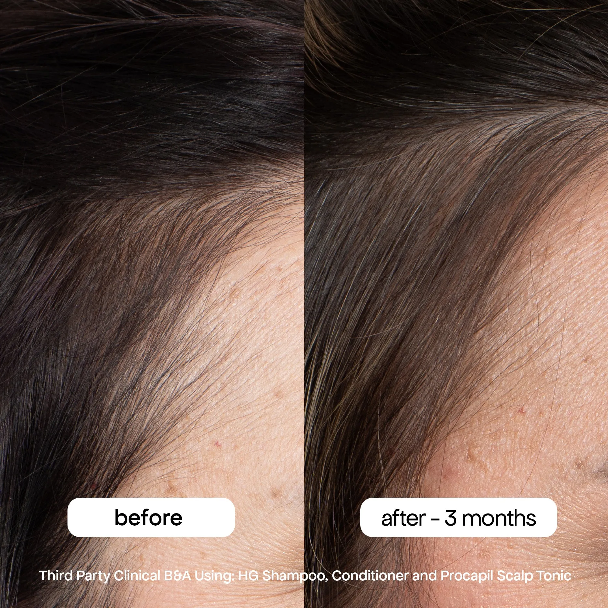MINI ANTI-THINNING PROCAPIL® SCALP TONIC