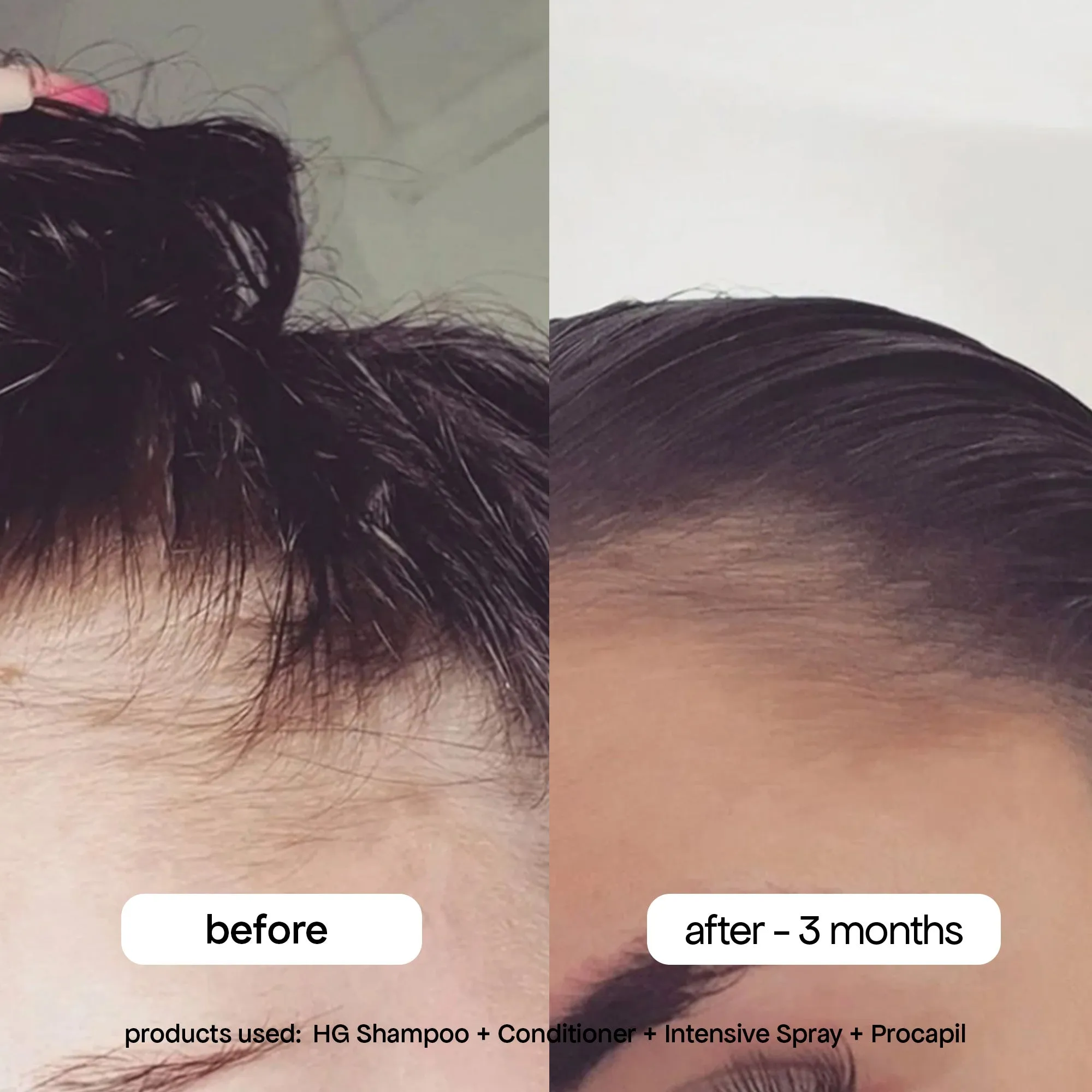 MINI ANTI-THINNING PROCAPIL® SCALP TONIC